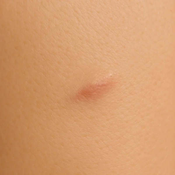 0 MG Beauty Clinic Patologia Dermatologica Foto Rimozione Lipoma