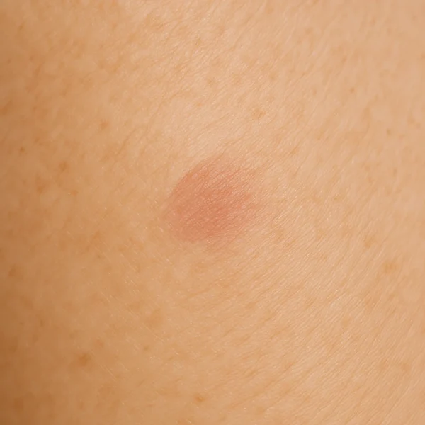 1 MG Beauty Clinic Patologia Dermatologica Cheratosi Sebboroica 3