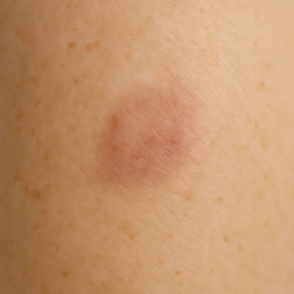 1 MG Beauty Clinic Patologia Dermatologica Cheratosi Sebboroica 1