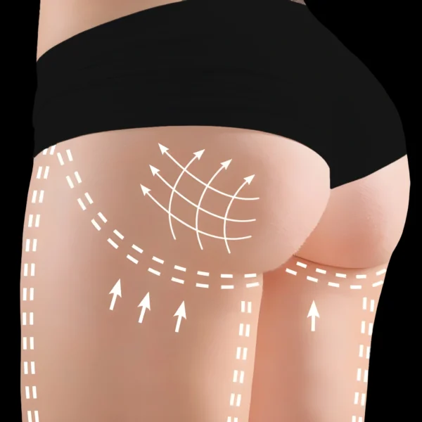 4 MG Beauty Clinic - Fili di Trazione Glutei