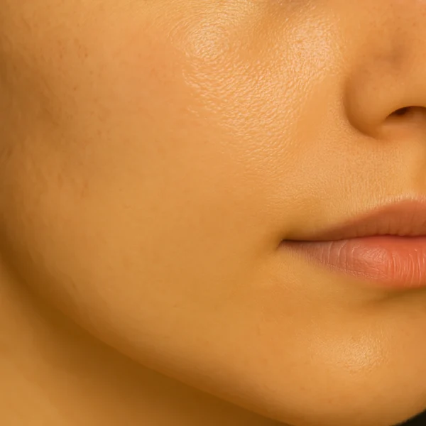 MG Beauty Clinc Foto Peeling Yellow Raccolte 3