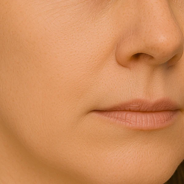 MG Beauty Clinic - Fili di Trazione Zigomi e Guance Dopo