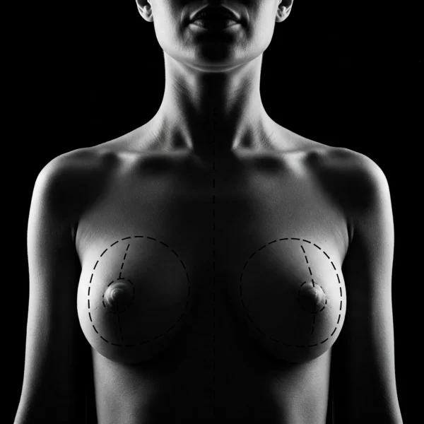 MG Beauty Clinic Foto Chirurgia Plastica Lipofilling Seno (2)