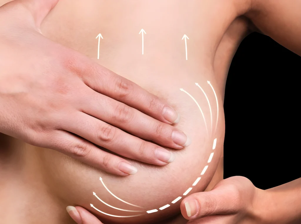 MG Beauty Clinic - Mastopessi Seno 2