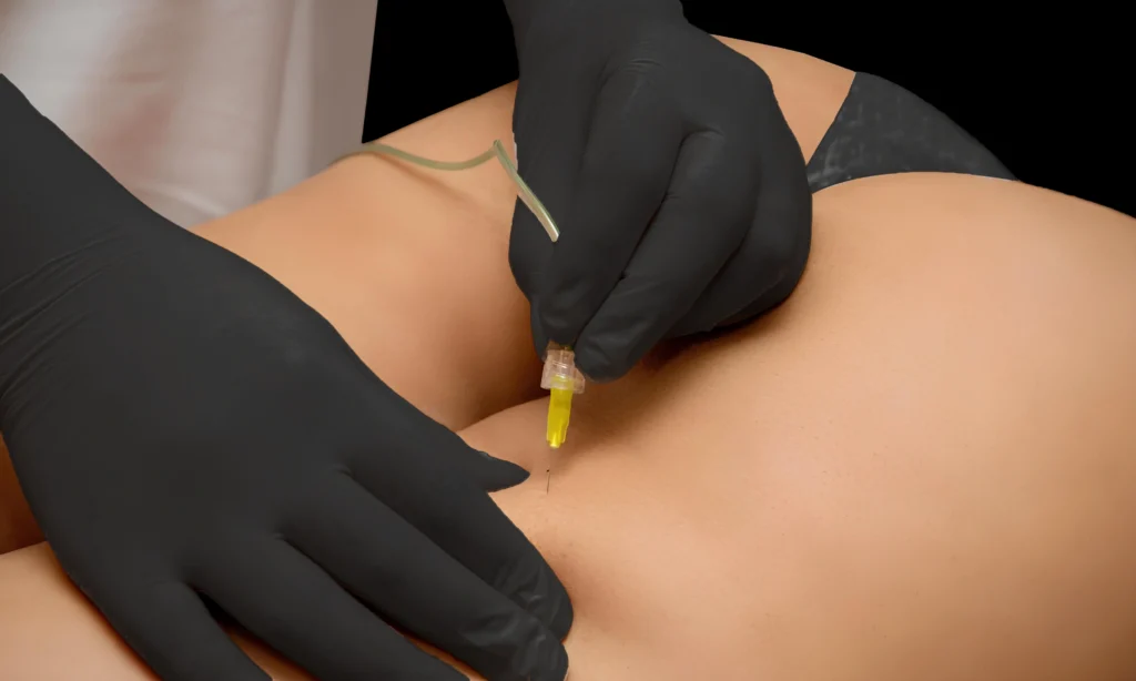 MG Beauty Clinic - Nuove Tecnologie Carbossiterapia (2)