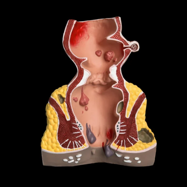 MG Beauty Clinic - Patologie Emorroidi Esterne (1)