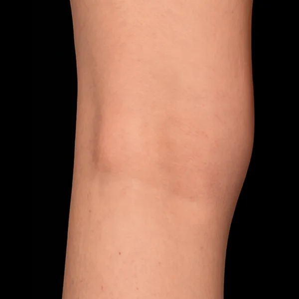 MG Beauty Clinic - Patologie Flebite superficiale dopo