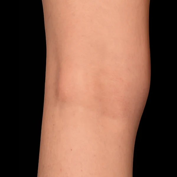 MG Beauty Clinic - Patologie Vene Reticolari dopo