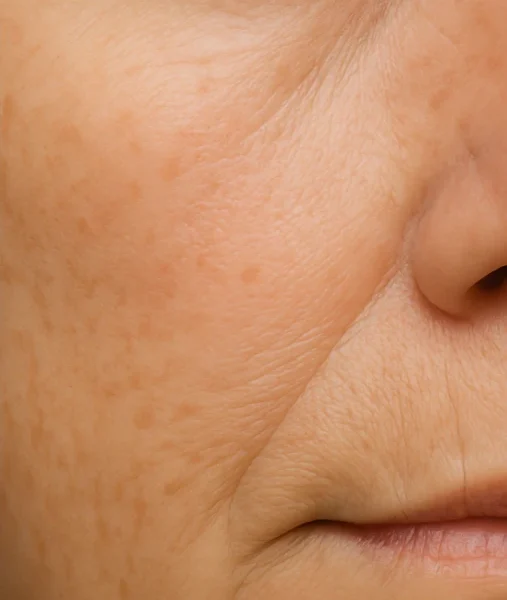 MG Beauty Clinic - Patologie Basalioma Dopo