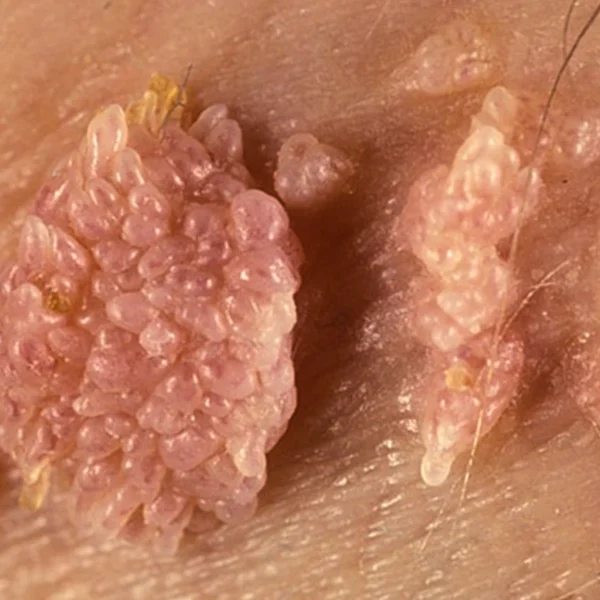 MG Beauty Clinic - Patologie Condilomi Genitali 1