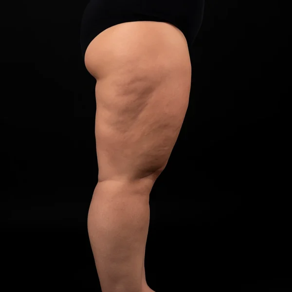 MG Beauty Clinic - Patologie Dermatofunzionali Lipolinfedema (1)