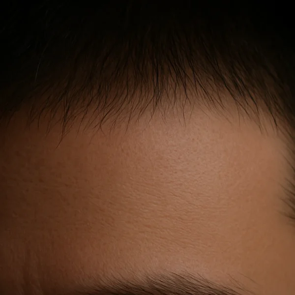 MG Beauty Clinic - Patologie Follicolite Semplice dopo