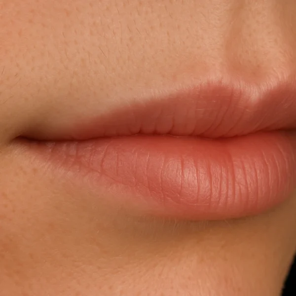 MG Beauty Clinic - Patologie Herpes Simplex dopo