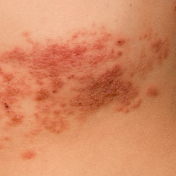 MG Beauty Clinic - Patologie Herpes Zoster Prima 2