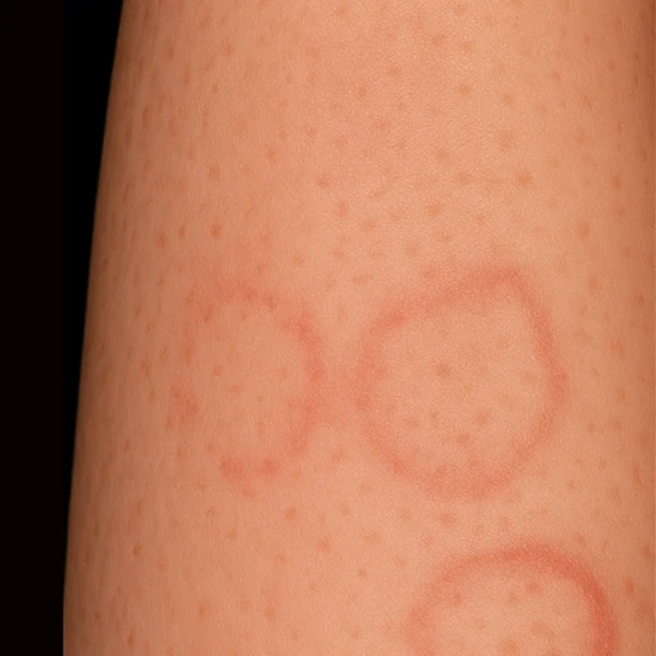 MG Beauty Clinic - Patologie Lupus Eritematoso Discoide dopo