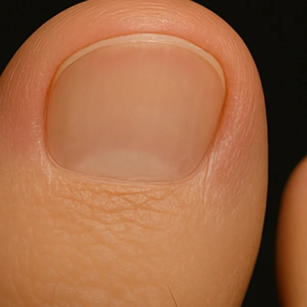 MG Beauty Clinic - Patologie Onicomicosi dopo