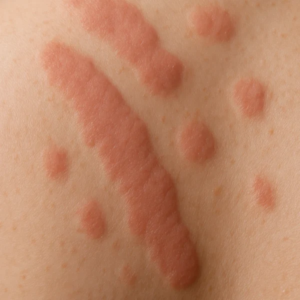 MG Beauty Clinic - Patologie Orticaria prima