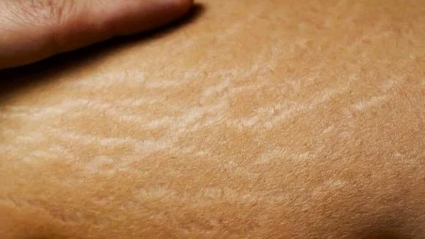 MG Beauty Clinic - Patologie Smagliature focus