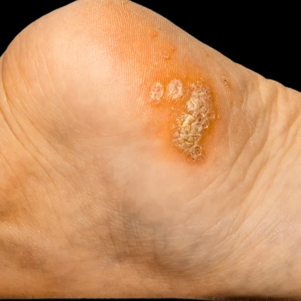 MG Beauty Clinic - Patologie Verruche prima