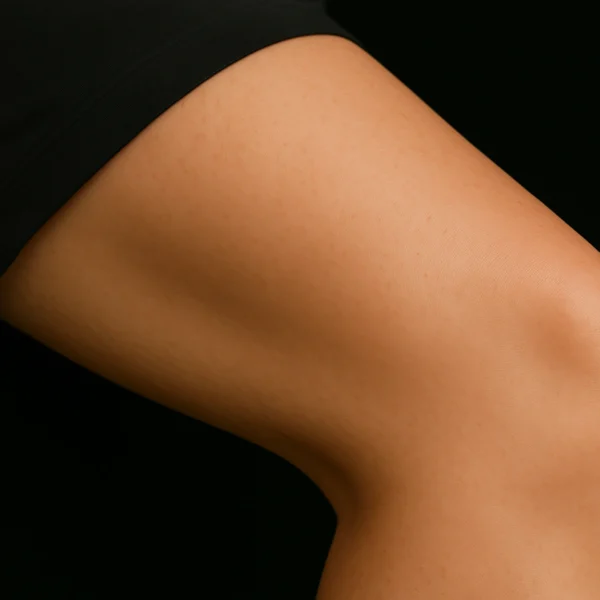 MG Beauty Clinic - Laser Vascolare Diodo Rimozione Capillari - dopo