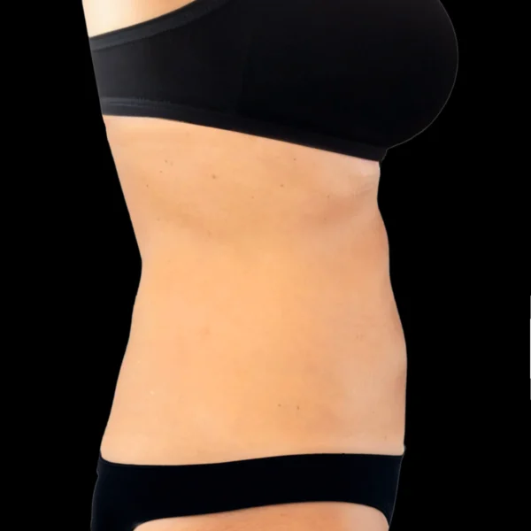 MG Beauty Clinic - Laser Shape - Dopo